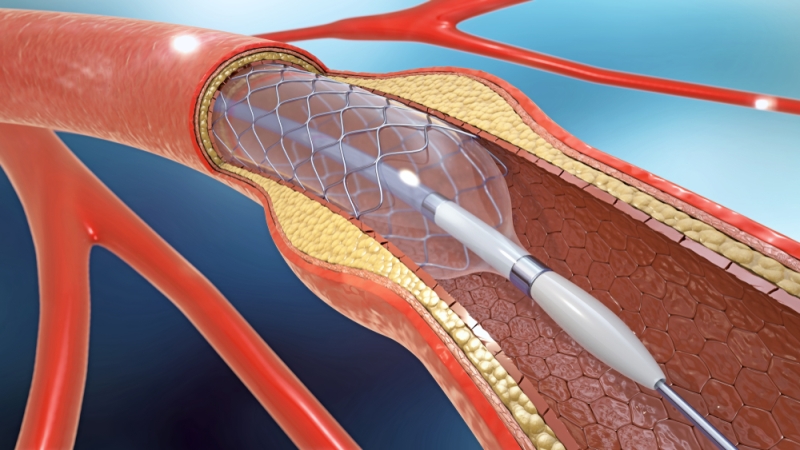 3d illustration of stent implantation for supporting blood circulation into blood vessels
